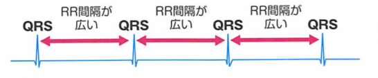 完全房室ブロックのQRS波