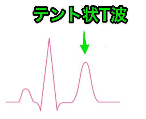 テント状T波