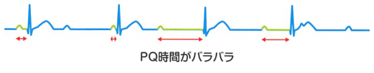 第3度房室ブロックの心電図