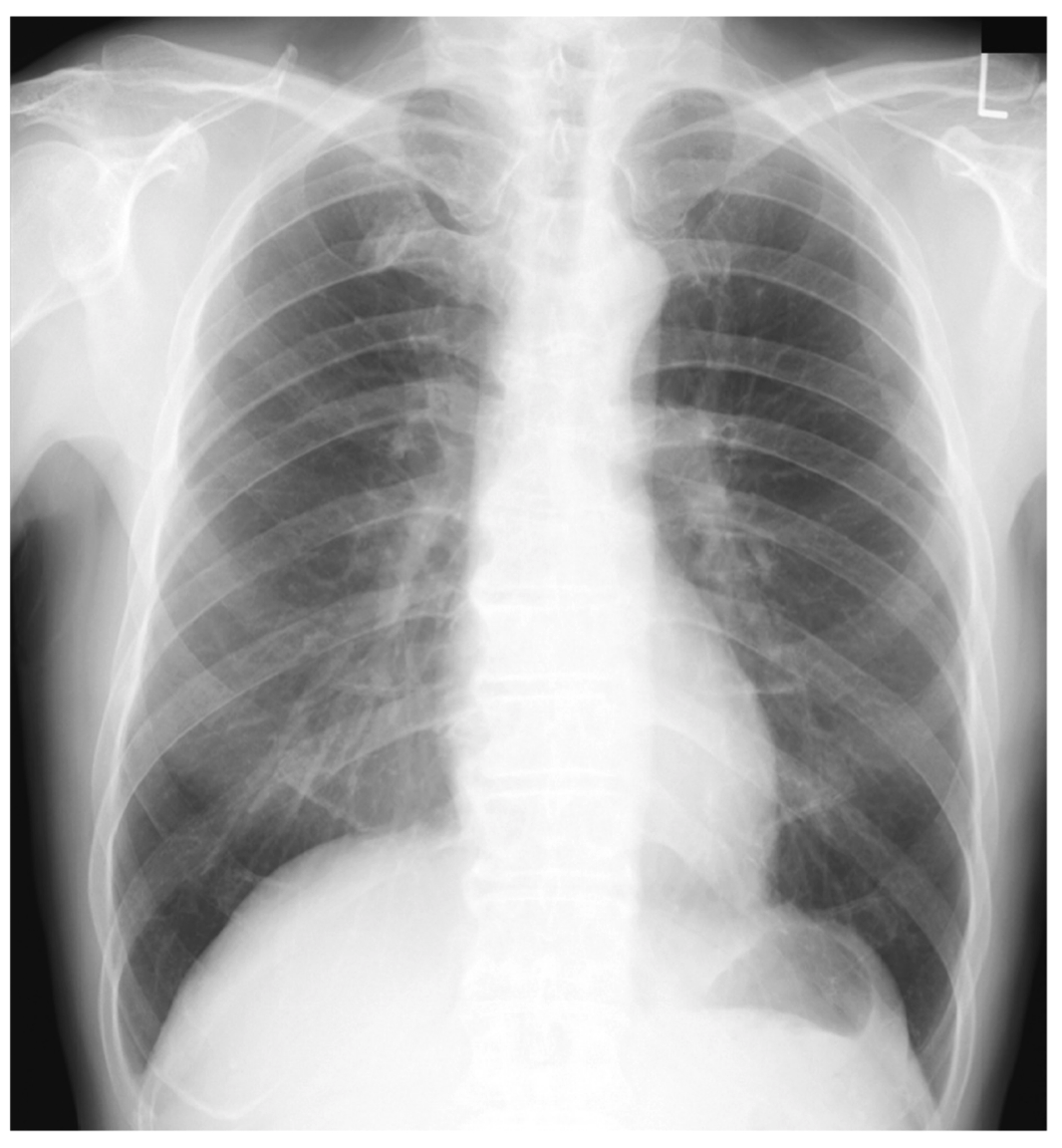 111E63_画像A_Wellens症候群の胸部レントゲン写真