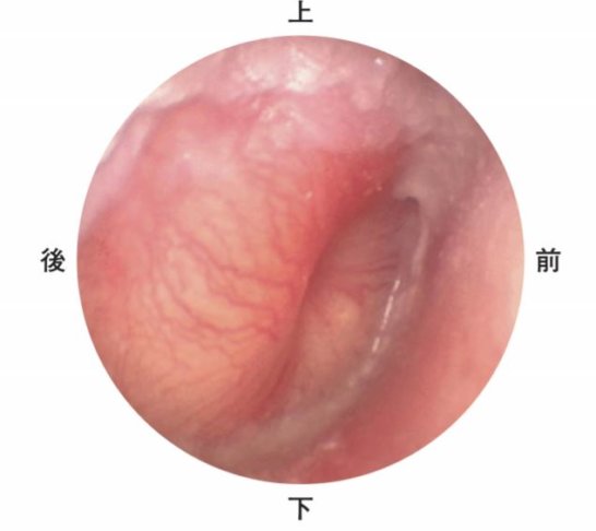 医師国家試験107A26_画像_急性中耳炎の耳鏡