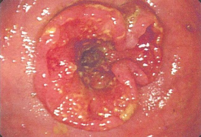 医師国家試験97C15_画像_結腸癌の下部内視鏡写真