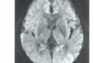医師国家試験99D103_画像5_MRIの拡散強調画像
